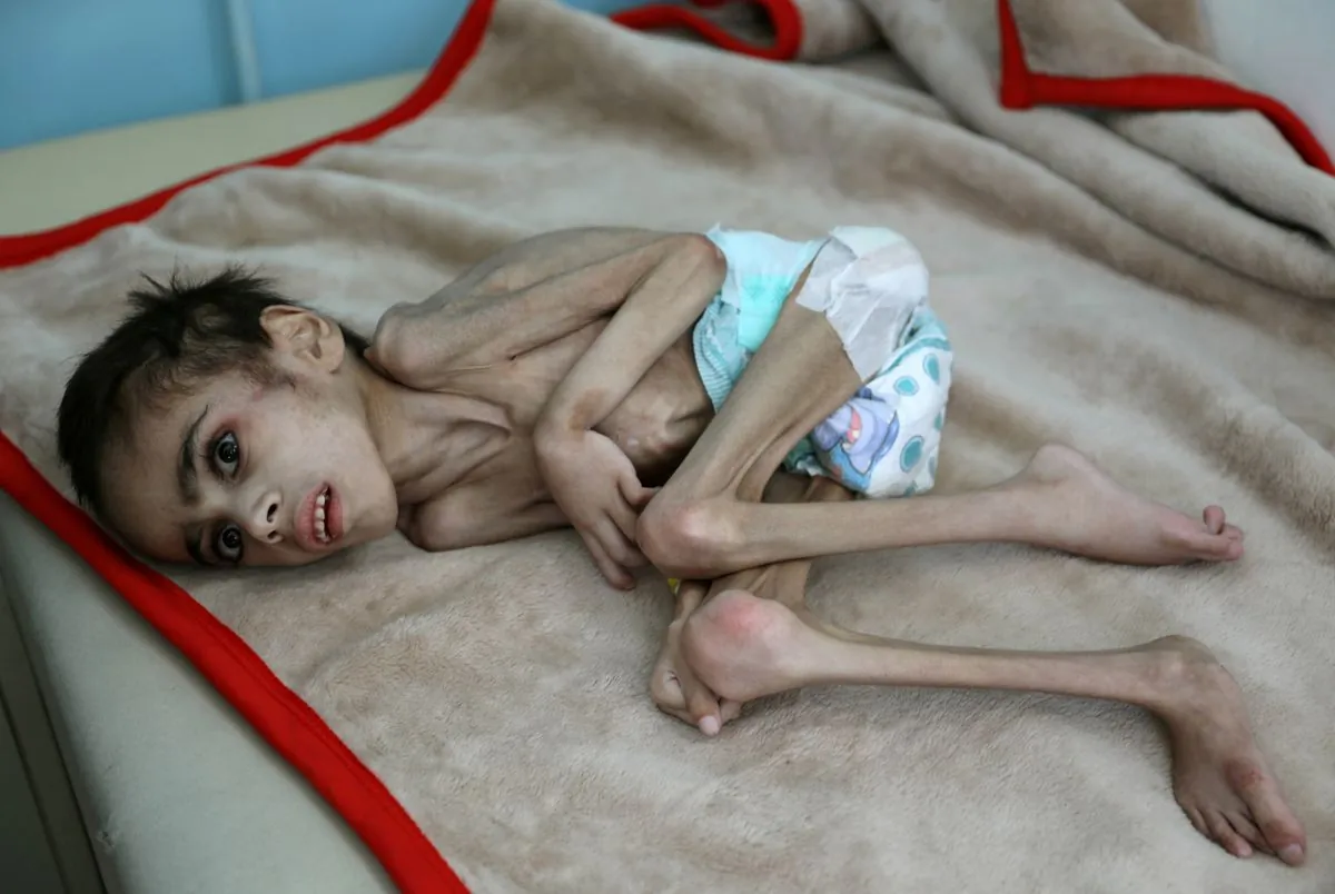 Yemen's Malnutrition Crisis Worsens, UN Report Reveals