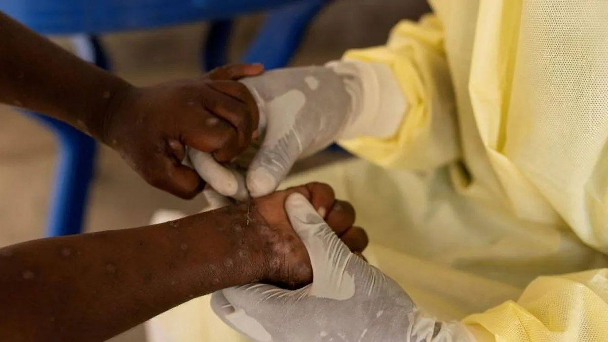 Uganda Reports Rise in Mpox Cases with More Transmissible Strain