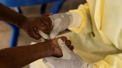 Uganda Reports Rise in Mpox Cases with More Transmissible Strain