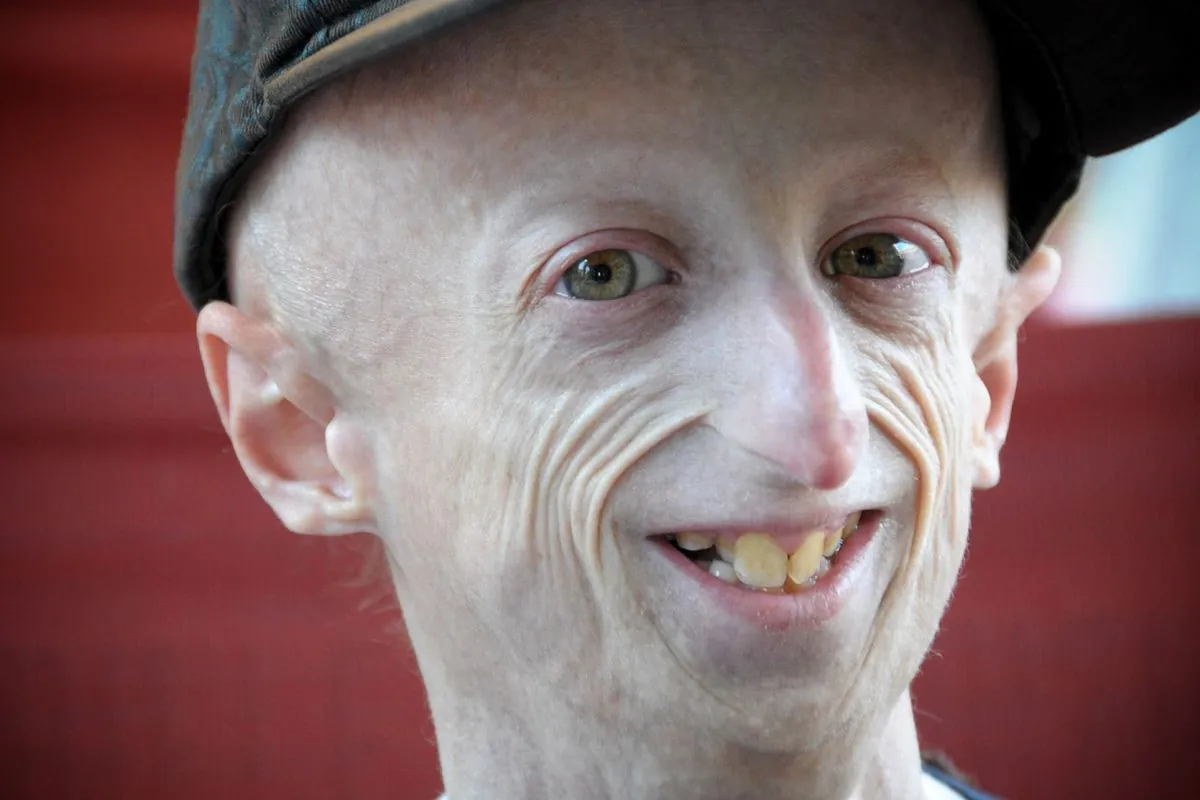 longest-living-progeria-survivor-sammy-basso-dies-at-28