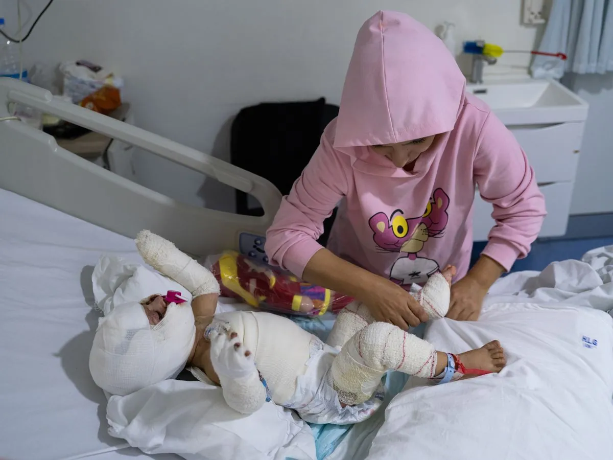 Tiny survivor at Beirut burn unit shows real cost of Middle East conflict